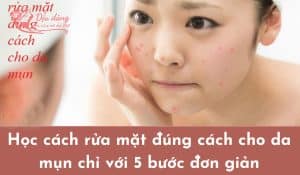 huong-dan-rua-mat-dung-cach-cho-da-dau-mun