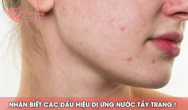 nhan-biet-cac-dau-hieu-di-ung-nuoc-tay-trang